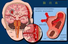 最为主要的梅毒的治疗措施