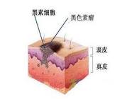 专家带您鉴别附睾炎