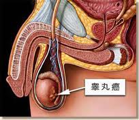 睾丸炎的危害到底有多大